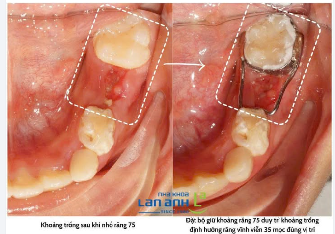 Muốn thành công phải biết "giữ khoảng cách". Trong nha khoa cũng vậy!