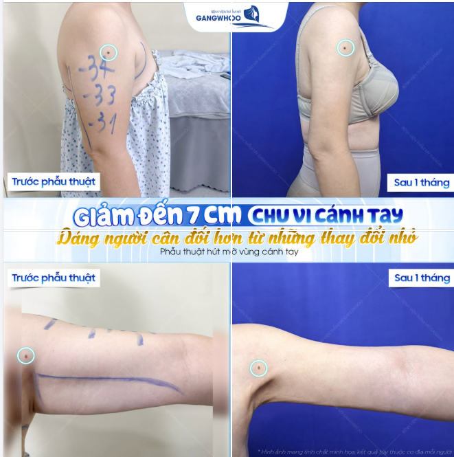 TỪ NGẠI MẶC ÁO SÁT NÁCH ĐẾN TỰ TIN KHOE DÁNG