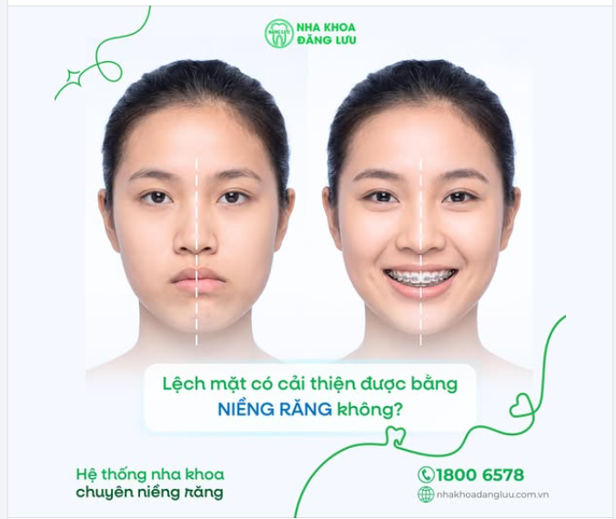 QA cùng bác sĩ Nha Khoa Đăng Lưu Lệch Mặt Có Cải Thiện Được Bằng Niềng Răng Không?