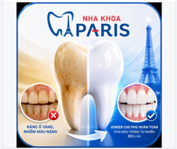 RĂNG Ố VÀNG, NHIỄM MÀU NẶNG?  VENEER SỨ – GIẢI PHÁP LẤY LẠI NỤ CƯỜI TRẮNG SÁNG