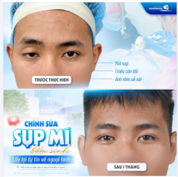 Chỉnh Sụp Mí Bẩm Sinh – Lấy Lại Tự Tin Ngoại Hình