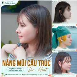 NÂNG MŨI CẤU TRÚC DR. HOẠT - X2 SỰ TỰ TIN CHỈ TRONG TÍC TẮC