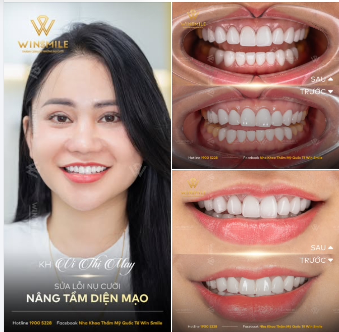 Sửa lại một nụ cười không ưng ý chưa bao giờ là quyết định dễ dàng.