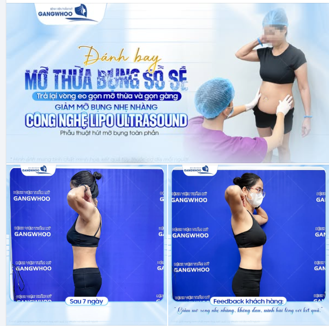 TRẢ LẠI VÒNG EO GỌN MỠ THỪA CHO MẸ 2 CON