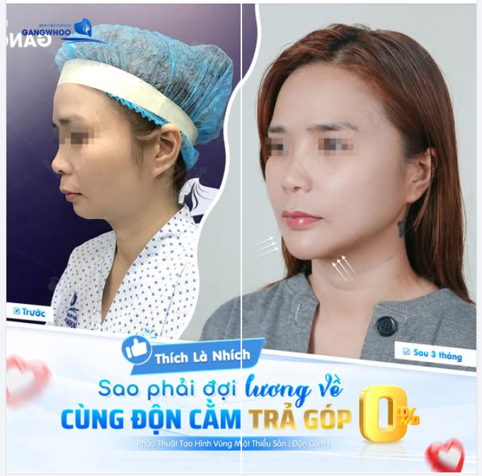 Thanh xuân qua đi không chờ đợi ai, cớ sao phải chần chừ việc yêu thương bản thân mình? Chốt deal làm đẹp ngay hôm nay để tậu chiếc cằm V-Line tỷ lệ vàng nhé!