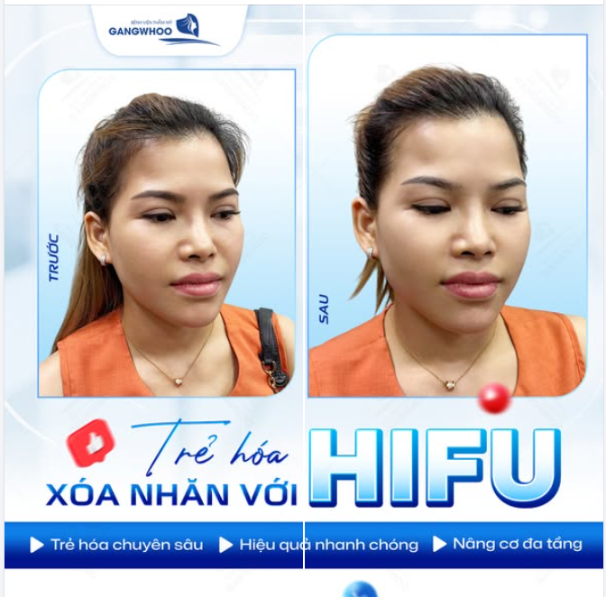 TRẺ HÓA XÓA NHĂN HIFU