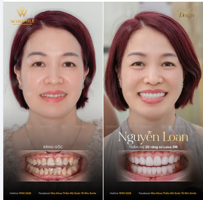 Nỗi sợ lớn nhất của một người phụ nữ trước khi quyết định thay đổi nụ cười là gì?