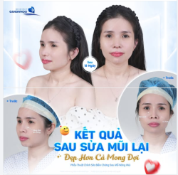 KẾT QUẢ SAU 15 NGÀY SỬA MŨI LẠI