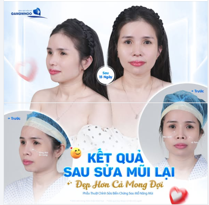 KẾT QUẢ SAU 15 NGÀY SỬA MŨI LẠI