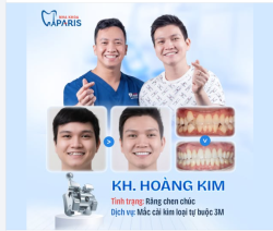 GÓC FEEDBACK: KHI RĂNG CHEN CHÚC TRỞ NÊN "THẲNG HÀNG" TĂM TẮP!