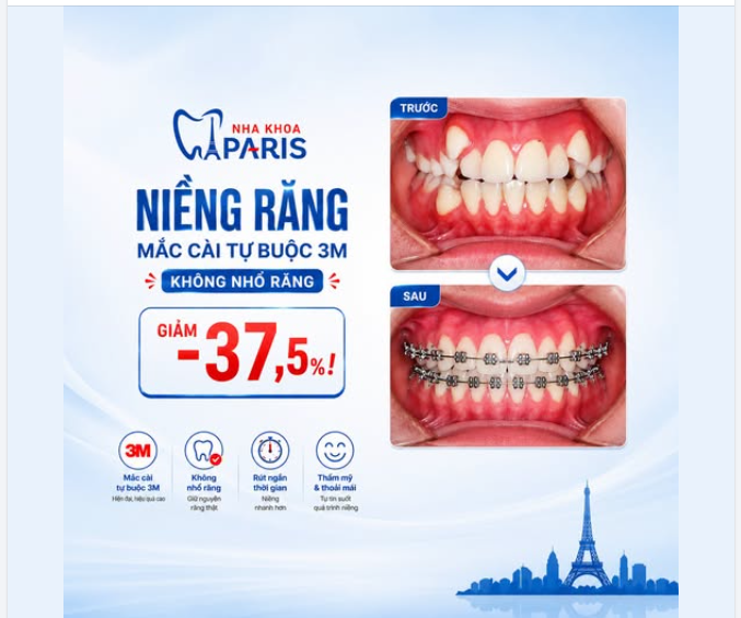NIỀNG RĂNG KHÔNG NHỔ RĂNG — RĂNG ĐỀU TĂM TẮP, GIẢM NGAY -37,5%!