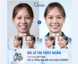 GÓC FEEDBACK: KẾT QUẢ NGỌT NGÀO SAU HÀNH TRÌNH NIỀNG RĂNG CÙNG NHA KHOA PARIS!