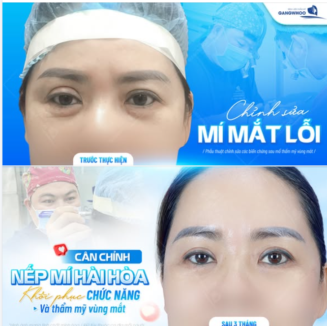 KHÔI PHỤC CHỨC NĂNG THẨM MỸ VÙNG MẮT