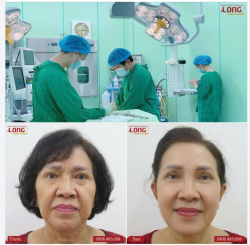 Tại sao ngày càng có nhiều khách hàng tìm đến PTTM Bác sĩ Long căng da mặt ?