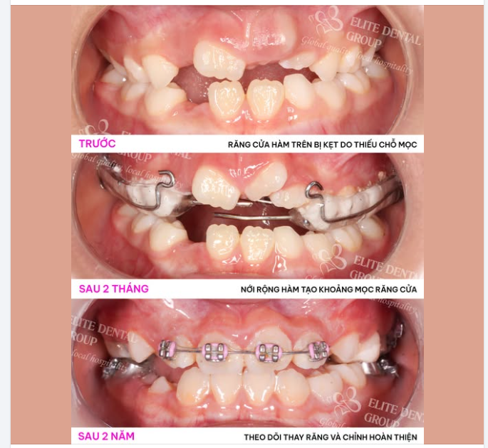 RĂNG SỮA ĐÃ RỤNG LÂU MÀ RĂNG VĨNH VIỄN CHƯA MỌC - CÓ ĐÁNG LO???