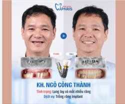 GÓC FEEDBACK: KHÔI PHỤC RĂNG KHỎE — AN TÂM VUI SỐNG!