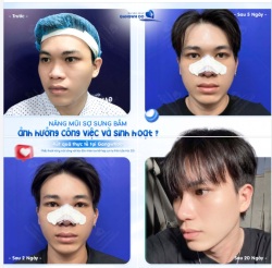 NÂNG MŨI SỢ SƯNG BẦM ẢNH HƯỞNG CÔNG VIỆC - SINH HOẠT