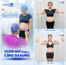 GIẢM MỠ KẾT HỢP CĂNG DA BỤNG