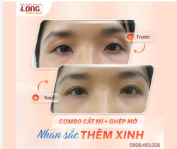 2 mí không đều, mắt trũng sâu làm thế nào ?