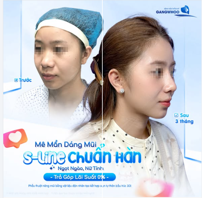 MÊ MẪN DÁNG MŨI S-LINE CHUẨN HÀN