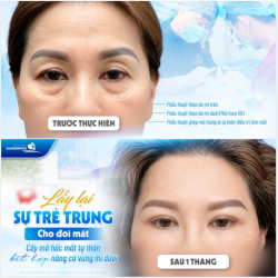 LẤY LẠI SỰ TRẺ TRUNG CHO ĐÔI MẮT
