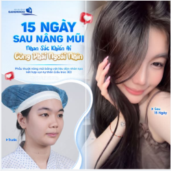 15 NGÀY SAU NÂNG MŨI