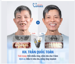TÁI SINH NỤ CƯỜI SAU PHỤC HÌNH RĂNG IMPLANT VÀ ĐIỀU TRỊ VIÊM NHA CHU TẠI NHA KHOA PARIS