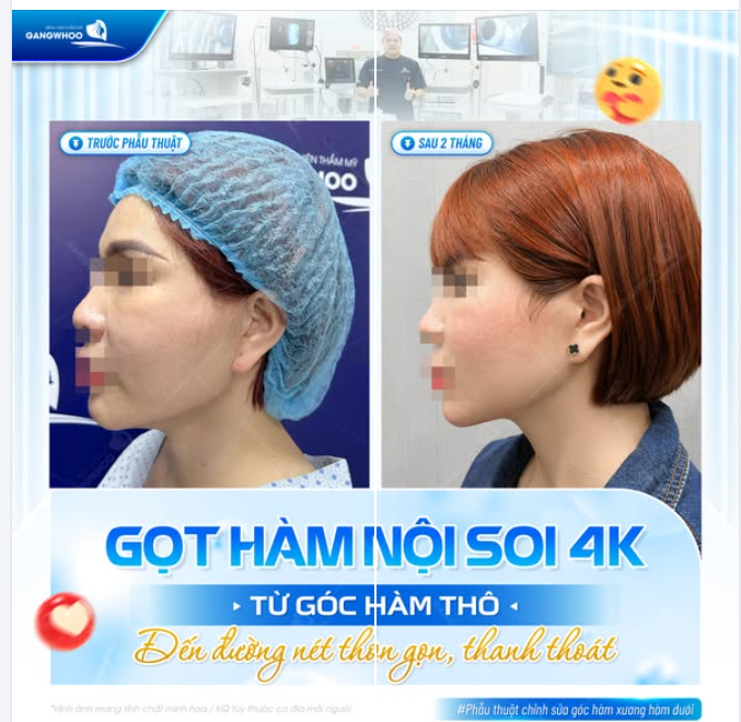 GỌT HÀM NỘI SOI 4K: ĐƯỜNG NÉT THON GỌN VÀ THANH THOÁT