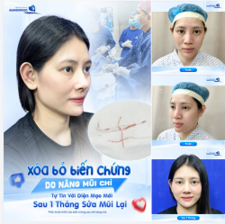 XÓA BỎ BIẾN CHỨNG DO NÂNG MŨI CHỈ
