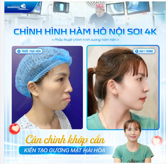 CHỈNH HÌNH HÀM HÔ NỘI SOI 4K