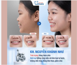 GÓC FEEDBACK: TẠM BIỆT RĂNG THƯA CHÌA - GÓC NGHIÊNG THAY ĐỔI NGOẠN MỤC!