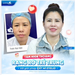 TẦM NHÌN THOÁNG – RẠNG RỠ TRẺ TRUNG HƠN