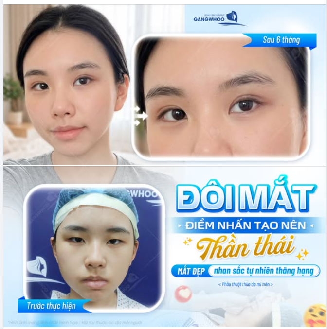 MẮT ĐẸP – NHAN SẮC TỰ NHIÊN THĂNG HẠNG