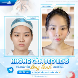 KHÔNG CẦN ĐEO LENS MÀ MẮT VẪN LONG LANH CUỐN HÚT