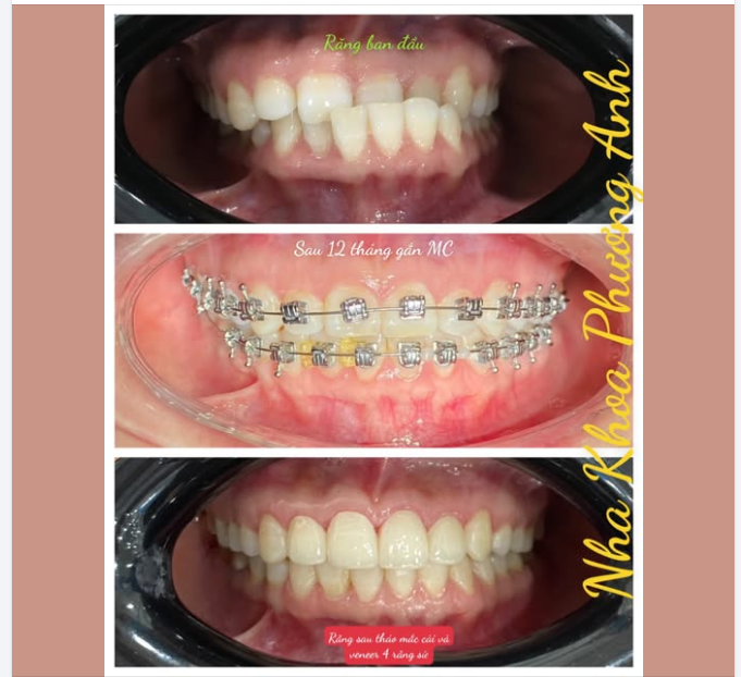 Kế hoạch điều trị chỉnh nha