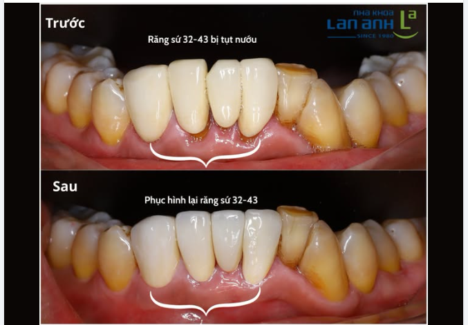 Không phải lúc nào vấn đề cũng nằm ở chiếc răng sứ.