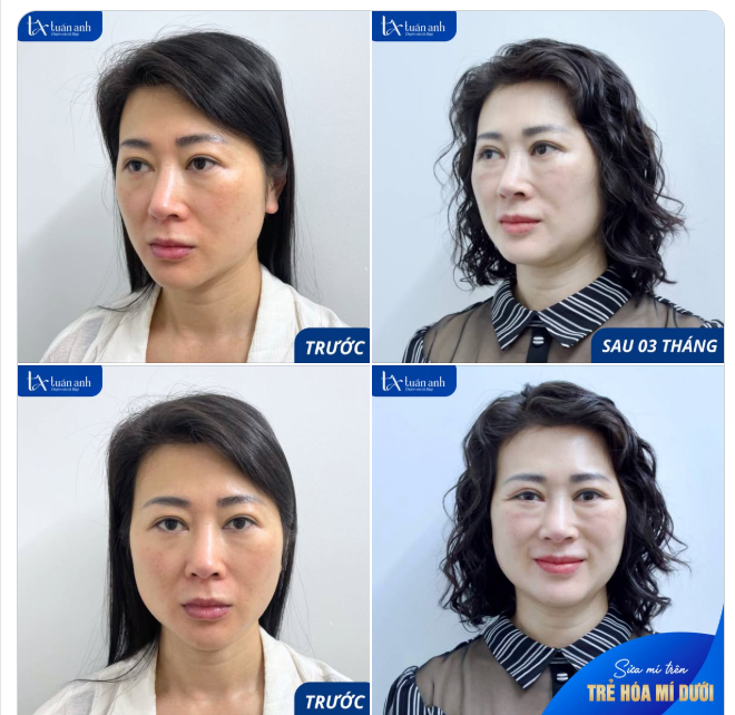 CHẠM TINH TẾ - TRẺ HÓA ÁNH NHÌN!