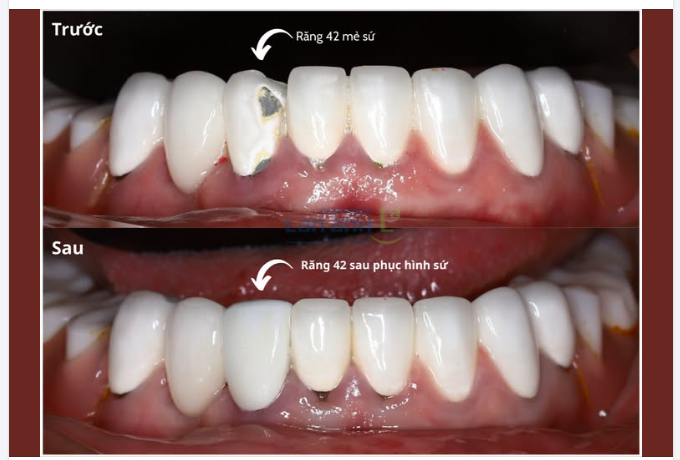 Cầu răng sứ bị bể một răng, có nhất thiết phải thay cả cầu?