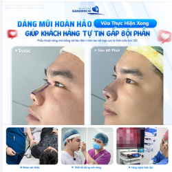 DÁNG MŨI HOÀN HẢO VỪA THỰC HIỆN XONG