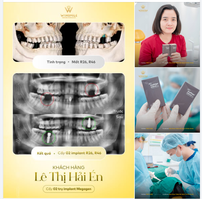 TƯ VẤN MINH BẠCH - TRỒNG RĂNG KHÔNG ĐAU TẠI WIN SMILE