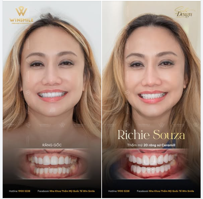 Chỉ vì 1 lần làm răng sứ hỏng mà sự tự tin vốn có trong con người chị Richie đã không được bộc lộ một cách thoải mái.