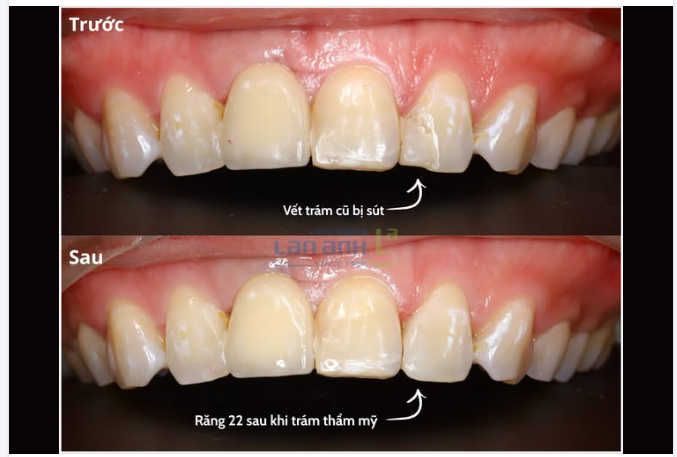 Răng 22 xin "nghỉ phép đột xuất" vì vết trám cũ bị sứt.