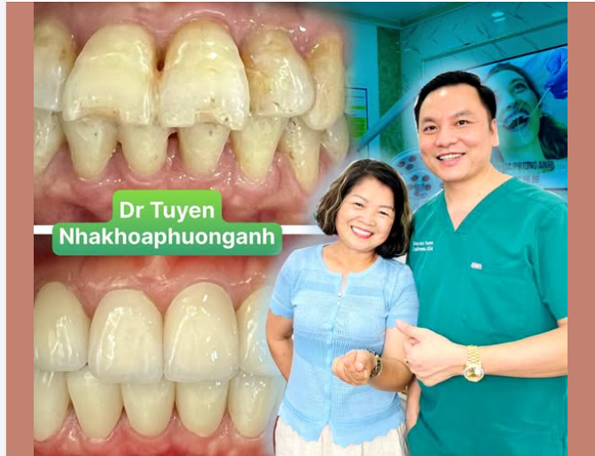 Bọc răng sứ có giống răng thật không?