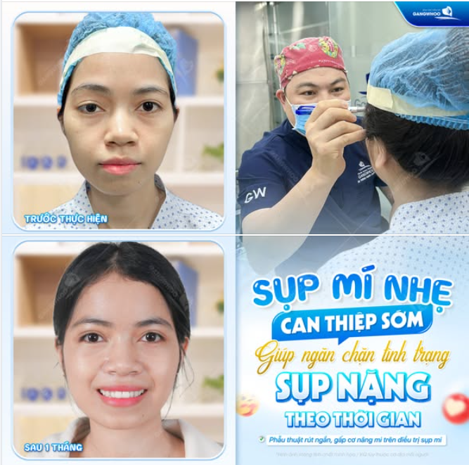 SỤP MÍ NHẸ – CAN THIỆP SỚM ĐỂ DUY TRÌ ĐÔI MẮT CÂN ĐỐI & TƯƠI TẮN