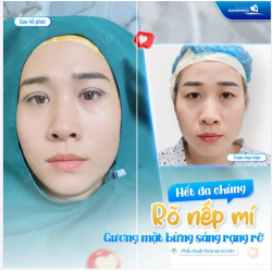 HẾT DA CHÙNG – RÕ NẾP MÍ, GƯƠNG MẶT BỪNG SÁNG