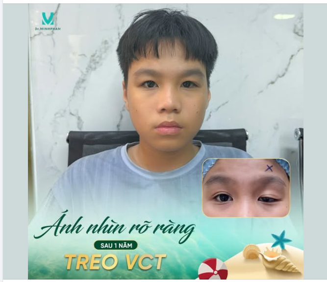 SAU 1 NĂM TREO VẠT CƠ TRÁN – ĐÔI MẮT TO TRÒN