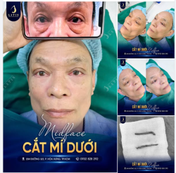 Không ít khách hàng bước qua tuổi 40 cảm thấy gương mặt ngày càng thiếu sức sống bởi bọng mắt lớn, vùng dưới mắt hõm sâu xuất hiện do lão hóa theo thời gian.