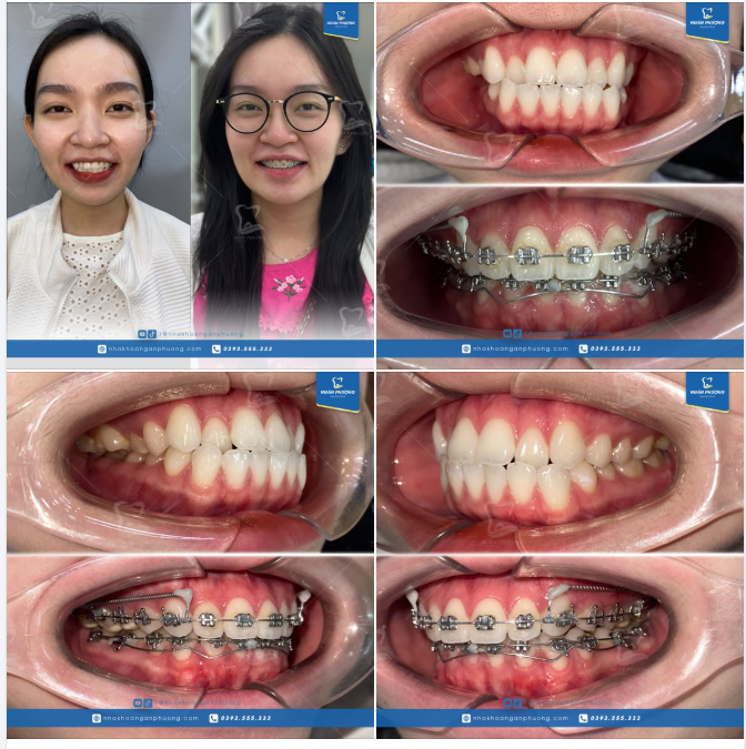 Khách iu Phương Nghi sắp được tháo niềng rồi đó