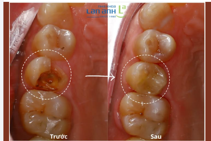 Miếng trám bong nhiều lần? Có lẽ chiếc răng đang cần một giải pháp khác.