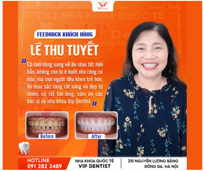 KHẮC PHỤC Ê BUỐT – RĂNG ĐẸP TỰ NHIÊN, CÔ TUYẾT TRẺ RA ĐẾN 10 TUỔI!